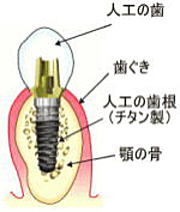 インプラントとは