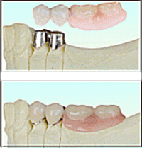 コーヌス・テレスコープ義歯　
