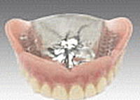 金属床総入れ歯